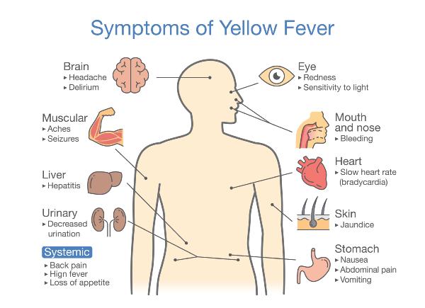 yellow fever symptoms - Sanjivani Ltd