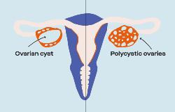 Polycystic Ovary Syndrome (Basic Profile)