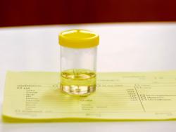 Cortisol Urine Test